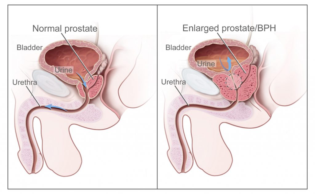 Comparison diagrams: image on left illustrates a normal-sized healthy prostate and image on the right illustrates an enlarged prostate. The male G-spot: getting a prostate massage.